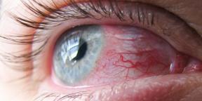 Conjuntivitis: ¿por qué enrojecer los ojos y cómo tratarlos