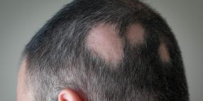 Alopecia: por qué está perdiendo cabello y cómo tratarlo