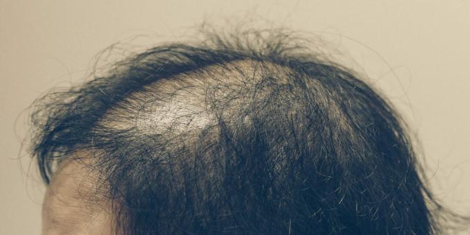 Alopecia anagénica