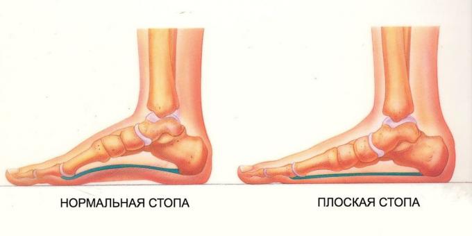 ejercicios para los pies planos: pie normal y plana