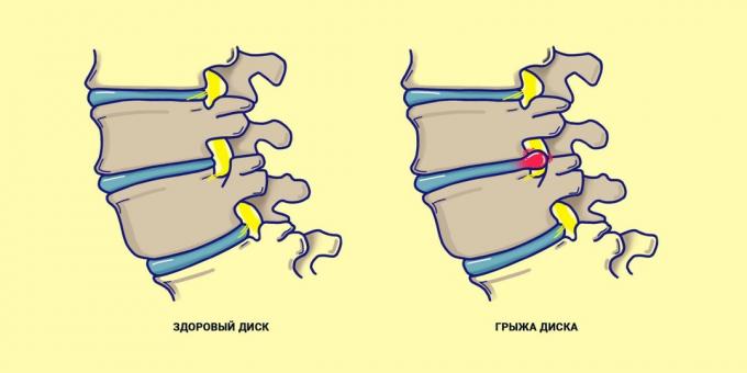columna vertebral hernia en comparación con una espalda sana