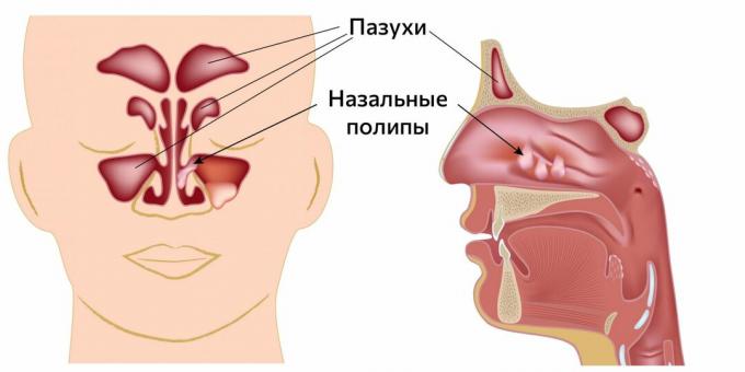 Pólipos en la nariz