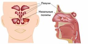 ¿Qué son los pólipos en la nariz y cómo se tratan?