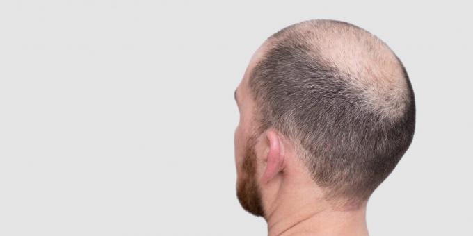 Alopecia telógena difusa
