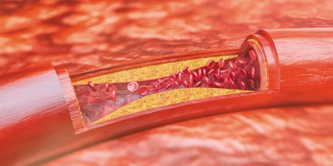 Colesterol: placas ateroscleróticas