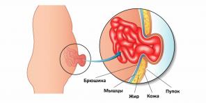 ¿De dónde viene una hernia umbilical y cómo tratarla?