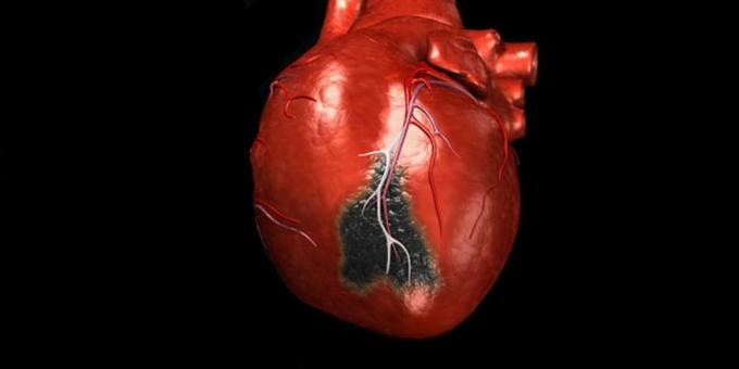 Los síntomas de un ataque al corazón, por lo que es necesario llamar a una ambulancia