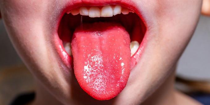 Síntomas de la escarlatina: lengua de fresa