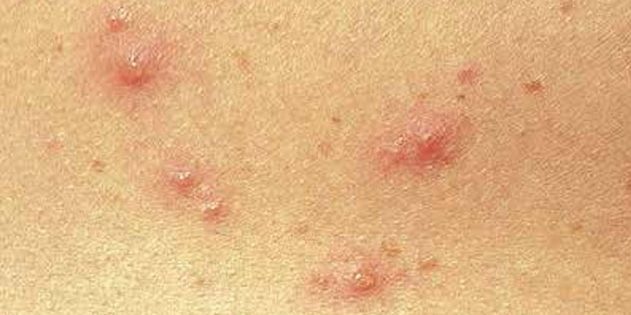 Los síntomas de la varicela en niños y adultos: Muy a menudo, la piel aparecen inmediatamente pequeños puntos rojos