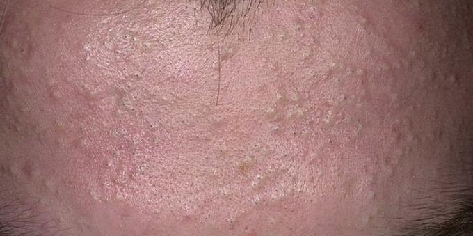¿Cómo deshacerse del acné: comedones cerrados
