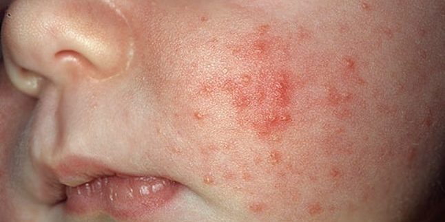 ¿Cómo deshacerse del acné: El acné infantil